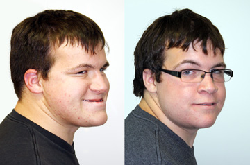 Clockwise Face Rotation and Chin Recontouring three-quaters view