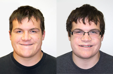 Clockwise Face Rotation and Chin Recontouring frontal view with smile