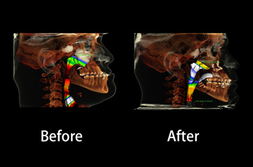 Clockwise Face Rotation and Chin Recontouring ct-scan view before and after