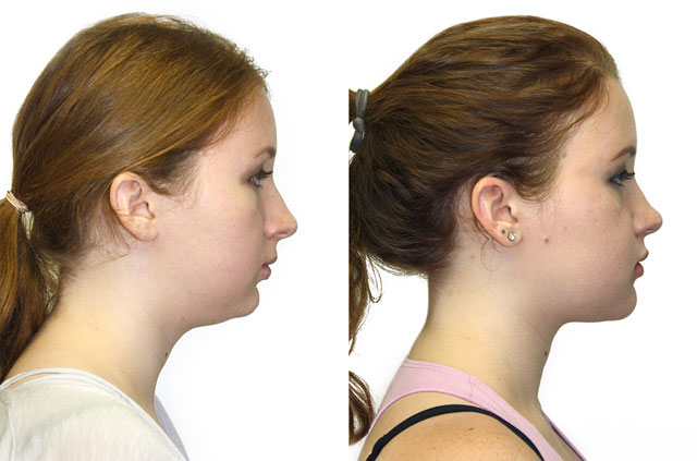 Face, Airway, and Bite Correction profile view no smile