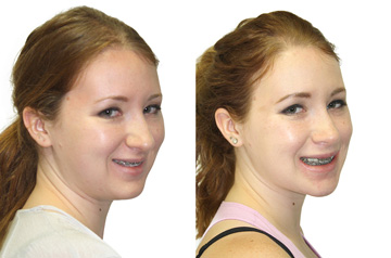 Face, Airway, and Bite Correction three-quaters view with smile