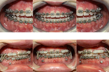 Face, Airway, and Bite Correction bite before and after
