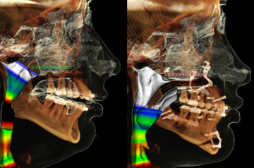 Face, Airway, and Bite Correction ct-scan before and after