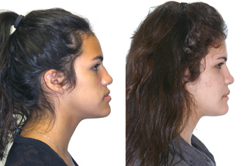 Corrective Jaw Surgery Case Profile No Smile