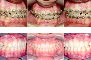 Corrective Jaw Surgery Case Bite Correction