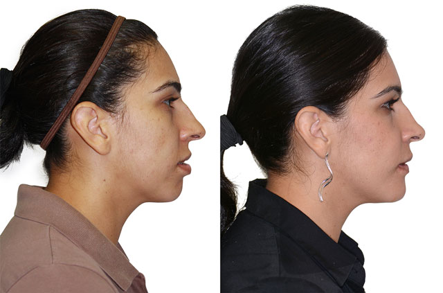 Orthognathic Surgery Case Performed at Mercy Hospital, Sacramento, California