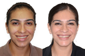Face asymmetry before and after frontal view picture with smile