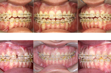 Face asymmetry before and after surgery bite picture