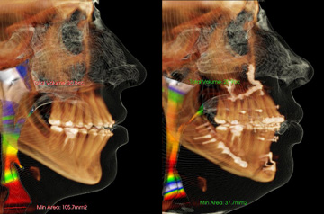 CT Scan asymmetry before and after surgery