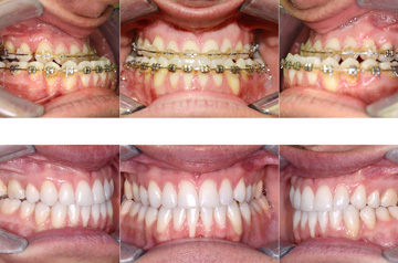 Corrective jaw surgery bite correction and cheek implants bite before and after