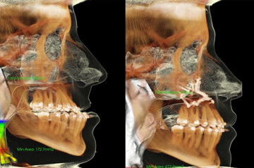 Corrective jaw surgery bite correction and cheek implants CT Scan before and after