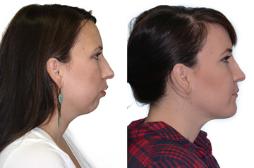 Corrective jaw surgery and bite correction profile view no smile