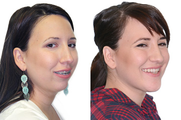 Corrective jaw surgery and bite correction three quaters view with smile