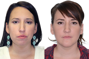 Corrective jaw surgery and bite correction front view with no smile