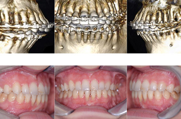 Corrective jaw surgery and bite correction profile view CT-Scan Before