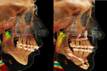 Corrective jaw surgery and bite correction profile view CT-Scan After