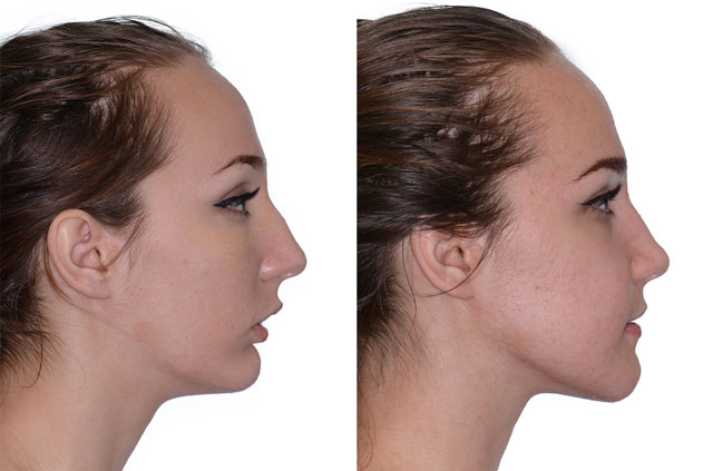 Corrective jaw surgery, chin asymmetry, and bite correction profile view no smile
