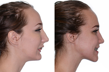 Corrective jaw surgery, chin asymmetry, and bite correction profile view with smile