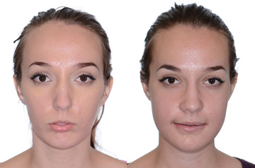 Corrective jaw surgery, chin asymmetry, and bite correction frontal view lips relaxed