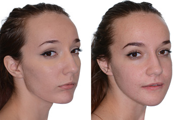 Corrective jaw surgery, chin asymmetry, and bite correction three quaters view lips relaxed