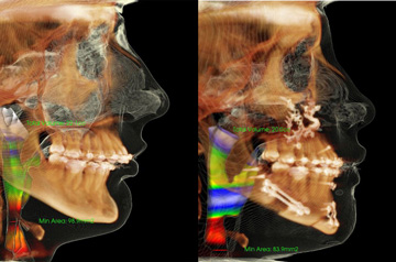 CT Scan Corrective jaw surgery, chin asymmetry Before and After