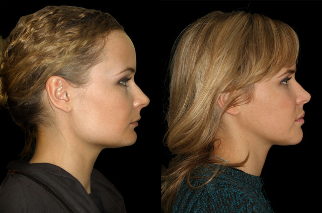 Corrective jaw surgery, chin asymmetry, and bite correction profile view no smile