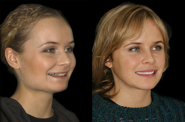 Corrective jaw surgery, chin asymmetry, and bite correction three quaters view lips relaxed