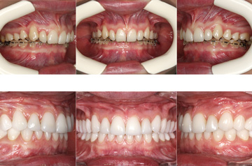 Bite before and after corrective jaw surgery, chin asymmetry, and bite correction orthognathic surgery case