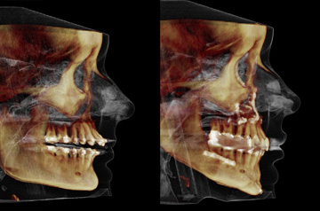 CT Scan before and after corrective jaw surgery, chin asymmetry, and bite correction orthognathic surgery case
