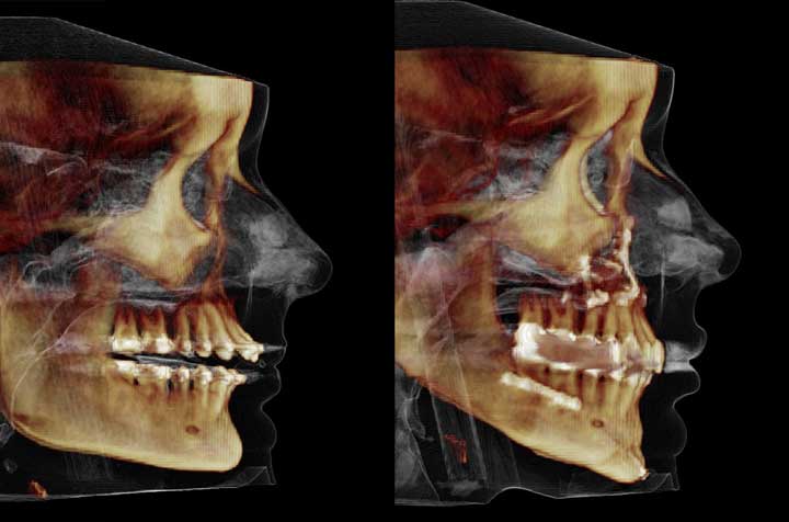 Orthognathic Facial Asymmetry Correction - Corrective Jaw Surgery - Dr