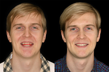 Face, Airway, and Bite Correction ct-scan before and after