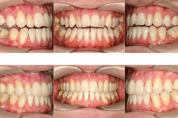 Bite before and after Face, Airway, and Bite Correction