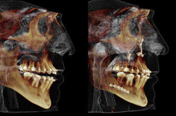 CT Scan before and after Face, Airway, and Bite Correction