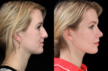 Contouring of the mandibular body profile view