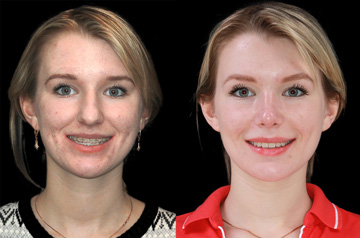 Contouring of the mandibular body chin up with smile before and after