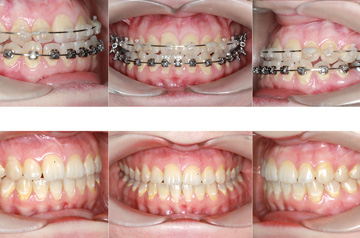 Bite before and after contouring of the mandibular body chin