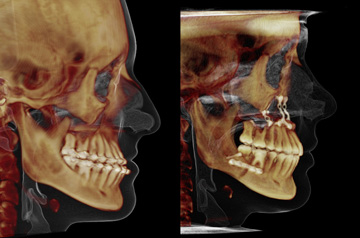 CT Scan before and after contouring of the mandibular body chin