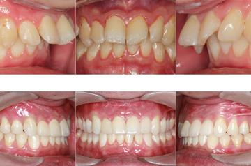 Upper and lower jaw advancement bite before and after
