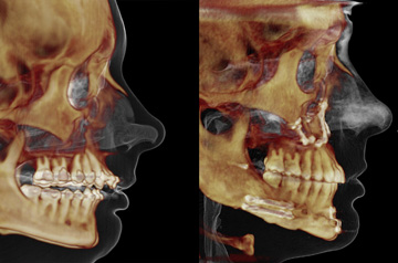 CT Scan Upper and lower jaw advancement Before and After