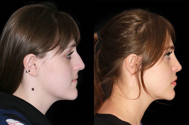 Contouring of the mandibular body profile view