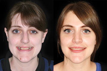 Contouring of the mandibular body profile view with smile