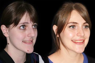 Contouring of the mandibular body chin up with smile before and after