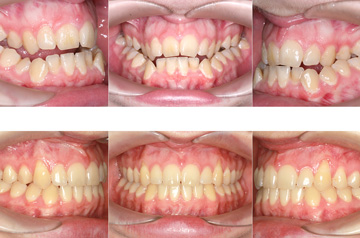 Bite before and after contouring of the mandibular body chin up