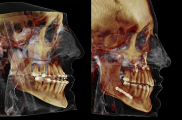 CT Scan before and after contouring of the mandibular body chin up