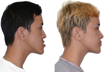 Photographs of the patient orthognathic surgery profile view Before and After with no smile