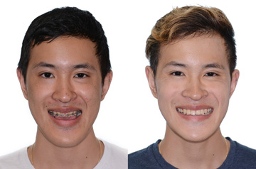 Photographs of the patient orthognathic surgery frontal view with smile