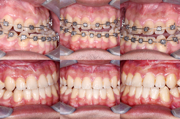 Bite Before and Afetr orthognathic surgery