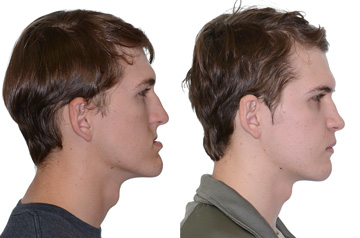 Photographs of the orthognathic surgery patient profile view with no smile