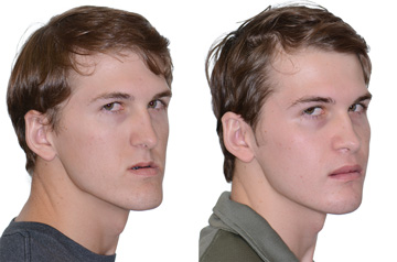 Orthognathic surgery three quaters view Before and After with no smile