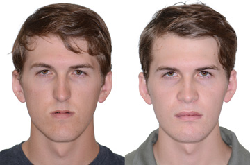 Orthognathic surgery frontal view Before and After with no smile